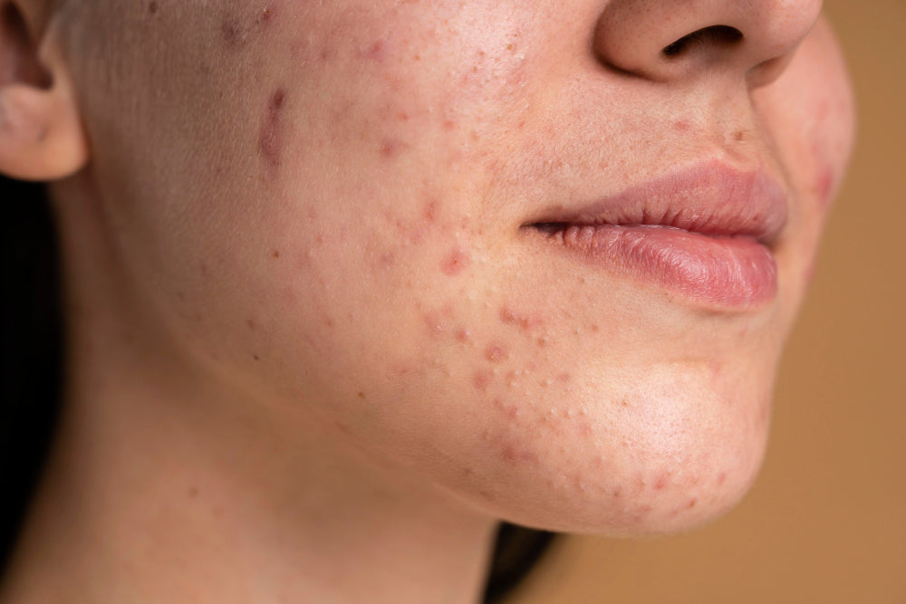 Integratori per acne – nutrienti per la pelle